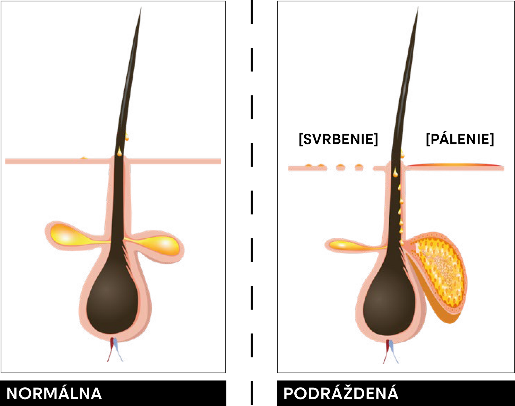 Podr&aacute;žden&aacute; vlasov&aacute; pokožka