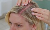 Suchá pokožka hlavy - hlavné príčiny a účinné riešenia